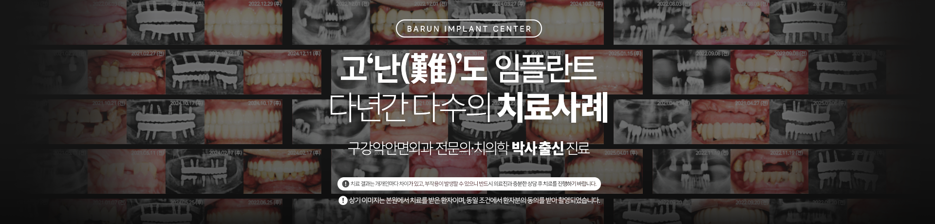 고난도 임플란트 다년간 다수의 치료사례