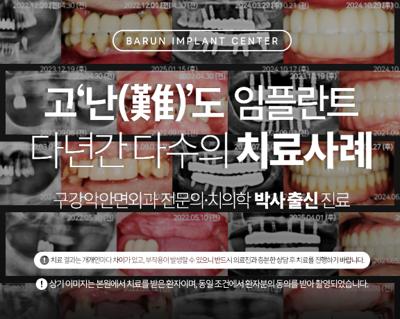 고난도 임플란트 다년간 다수의 치료사례