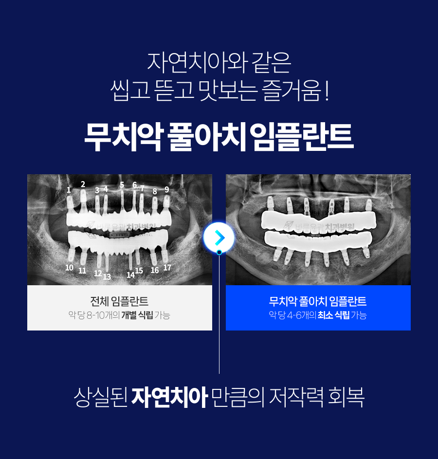 무치악 풀아치 임플란트