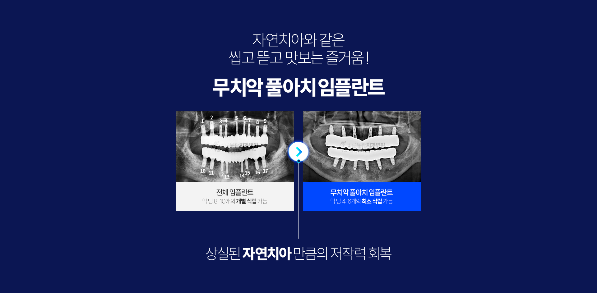 무치악 풀아치 임플란트