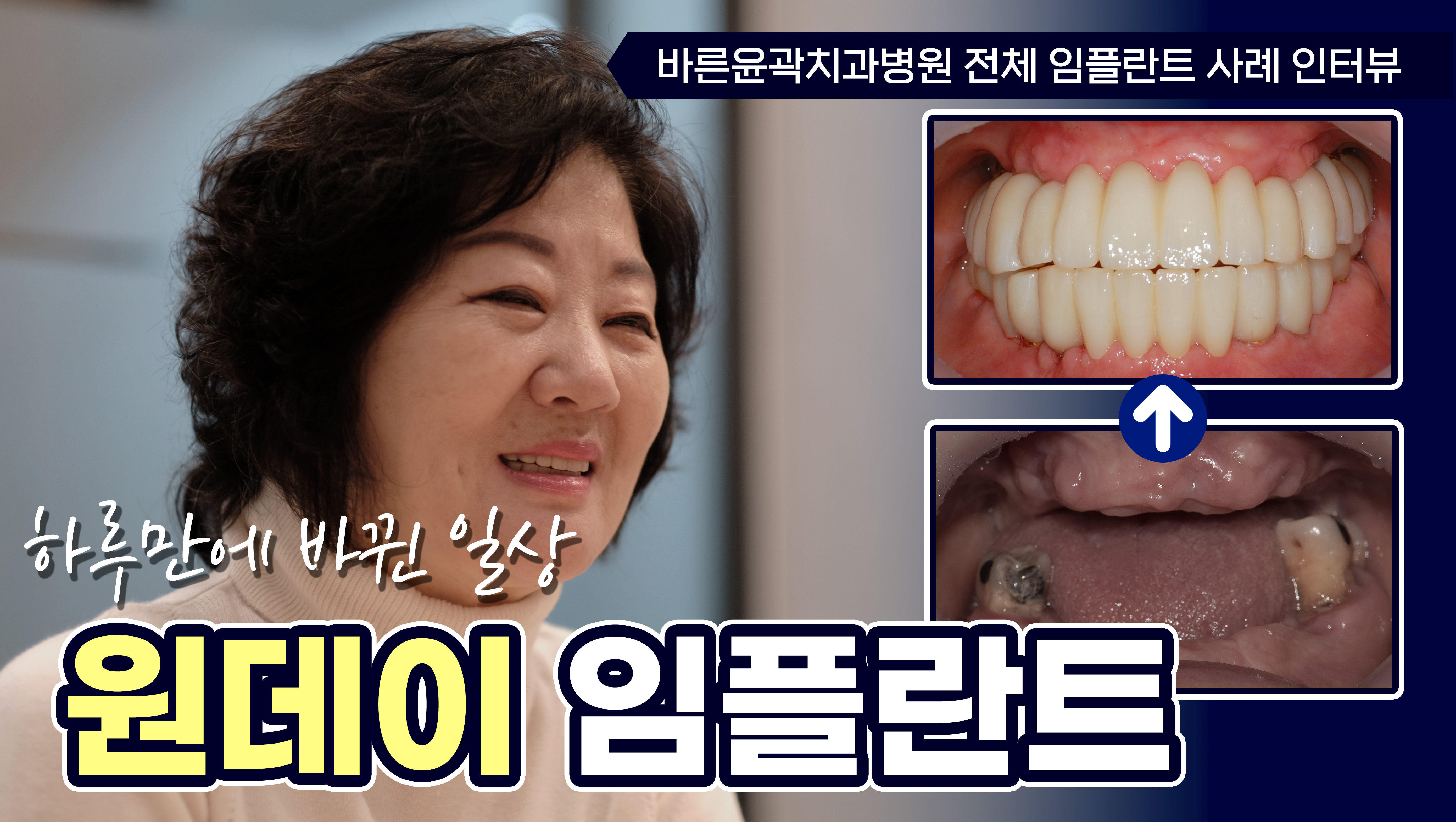 디지털 임플란트 치료사례