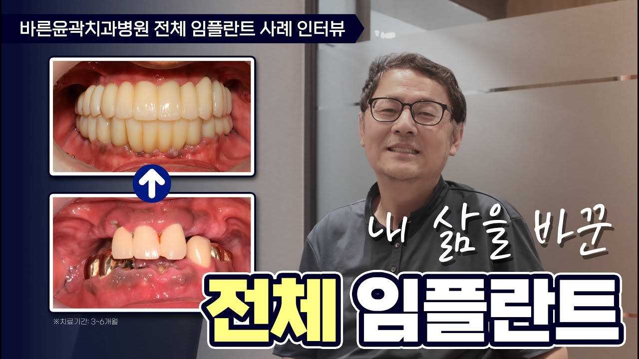 디지털 임플란트 치료사례