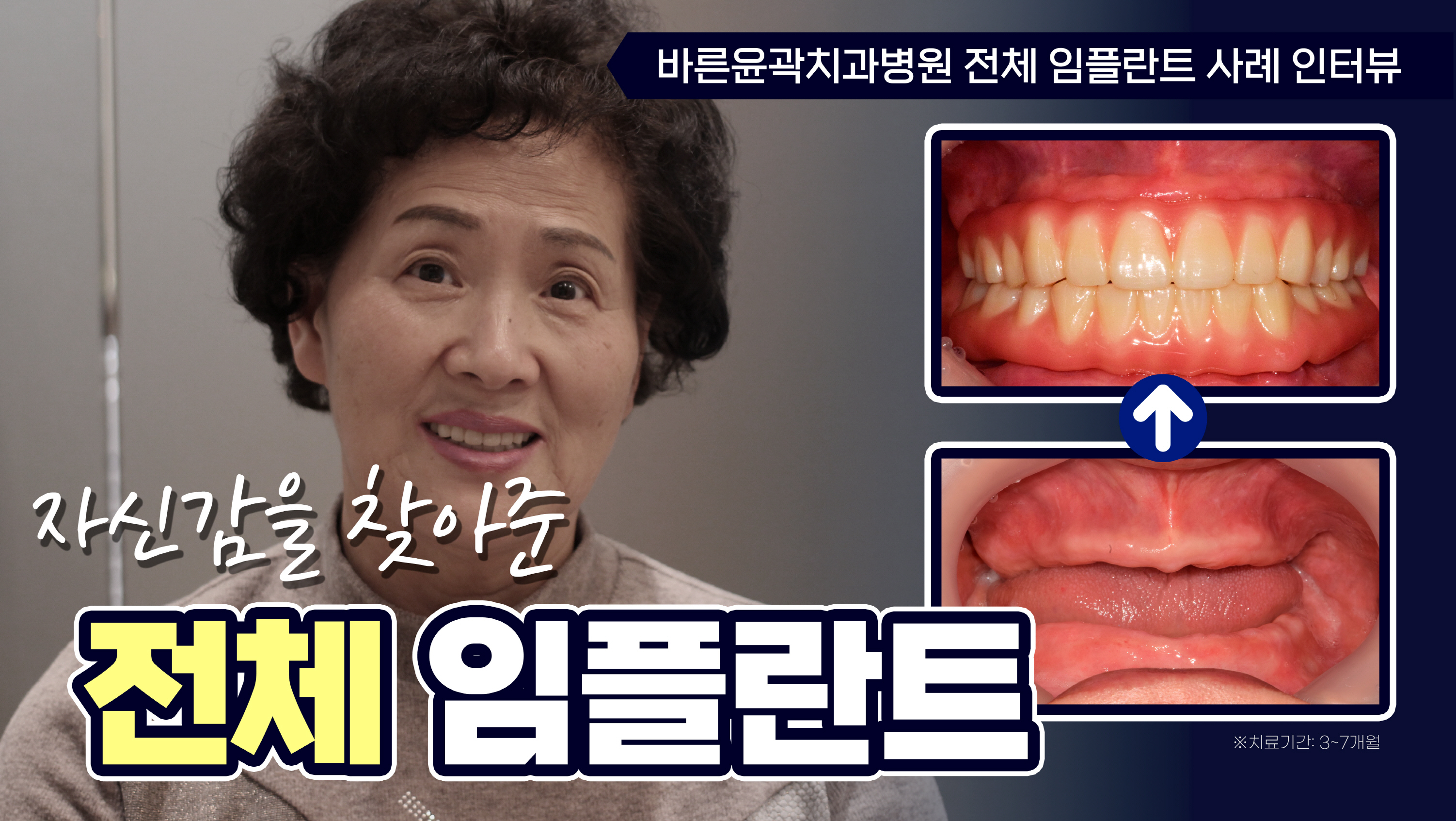 디지털 임플란트 치료사례